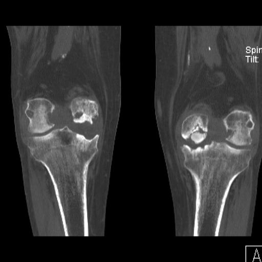Как делают кт коленного сустава