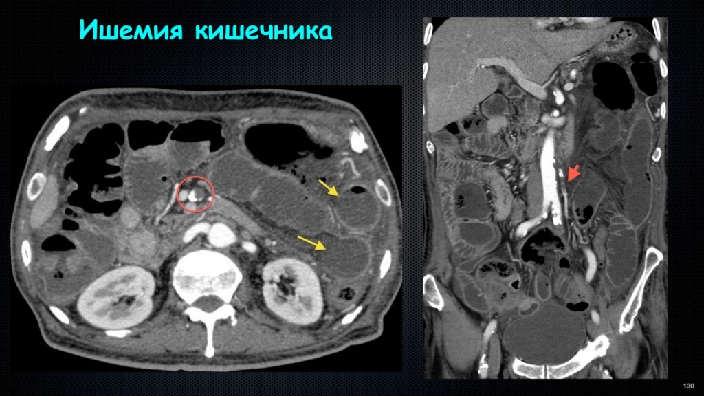 Синдром мезентериальной ишемии презентация