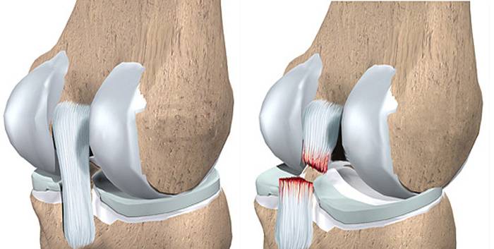 Связка мениска колена. Разрыв мениска и крестообразной связки. Разрыв крестообразной связки коленного сустава.