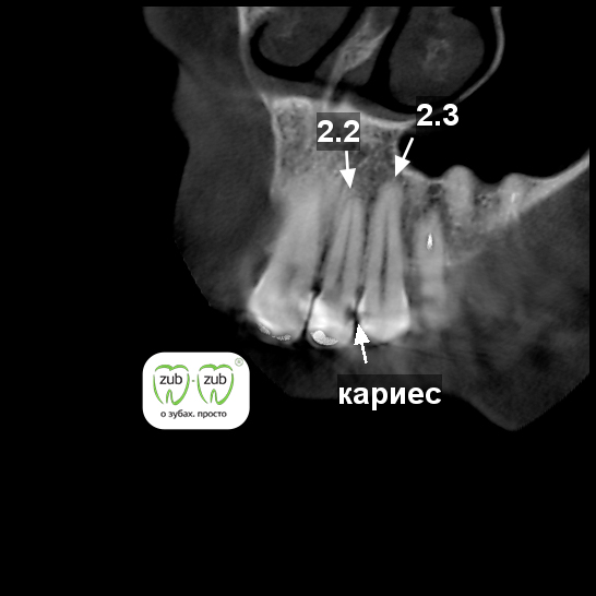 Кариес корня зуба фото