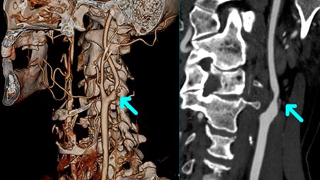 Мрт сосудов шеи. Кт ангиография брахиоцефальных артерий. Стеноз сонной артерии кт. Ангиограмма позвоночной артерии. Кт ангиография брахиоцефальных сосудов.