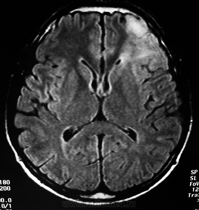 Показывает ли кт опухоль мозга. Глиома лобной доли мрт. Опухоль головного глиома кт. Глиома головного мозга кт.