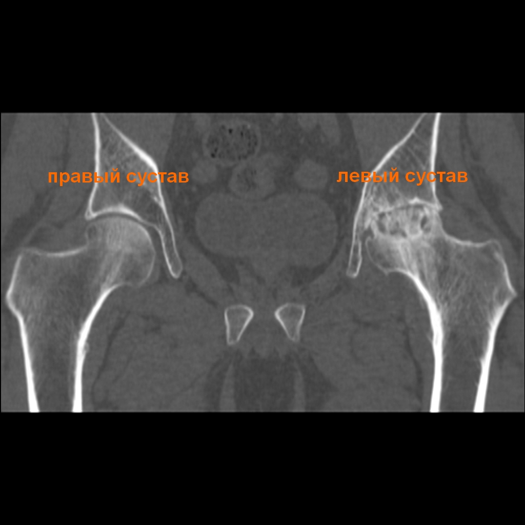Коксартроз мрт или кт