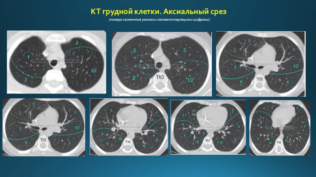 Кт здоровых легких фото