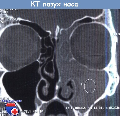 Узи пазух носа. Кт пазух носа в 2 проекциях. Решетчатые пазухи носа кт. При воспалении пазух носа кт.