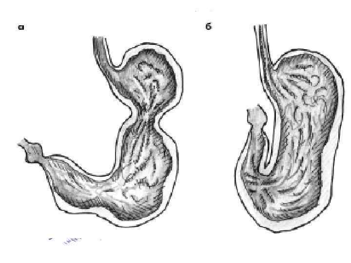 Час желудка. Каскадная деформация желудка. Каскадный Перегиб желудка. Каскадная форма желудка. Деформация желудка по типу песочных часов.