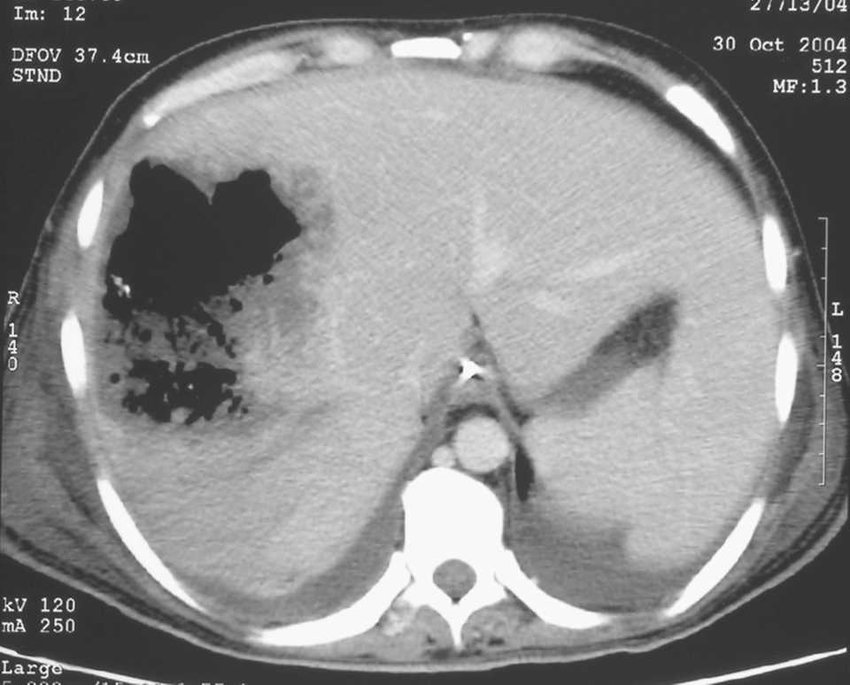 Абсцесс печени кт картина