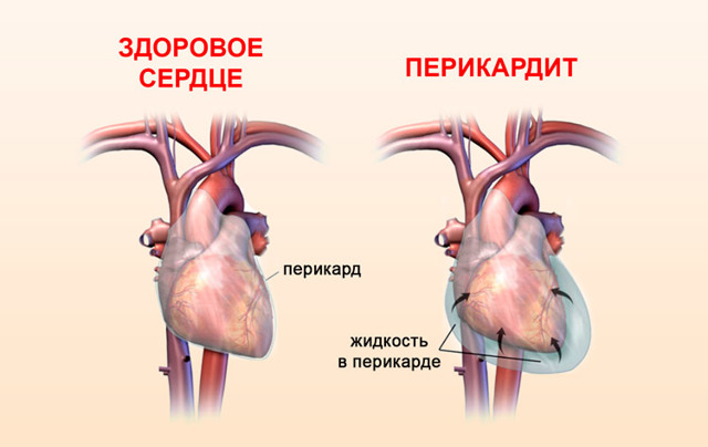 Нарушение работы клапана сердца