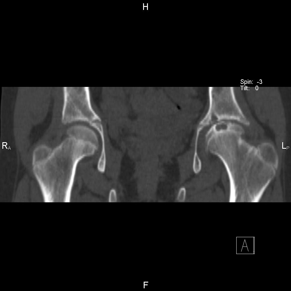 Асептический коксартроз. Артрит тазобедренного сустава кт. Асептический некроз кости на кт.