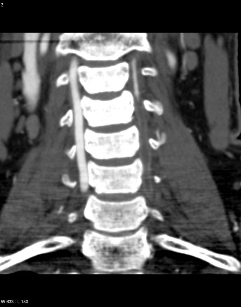 Кт шеи. Диссекция позвоночной артерии мрт. Диссекция позвоночной артерии на кт.