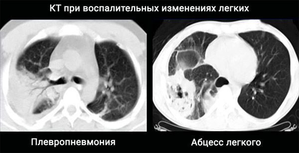 Изменения на компьютерной томографии легких при первичных вирусных пневмониях