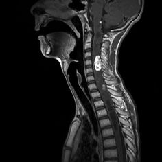 МРТ – опухоль спинного мозга