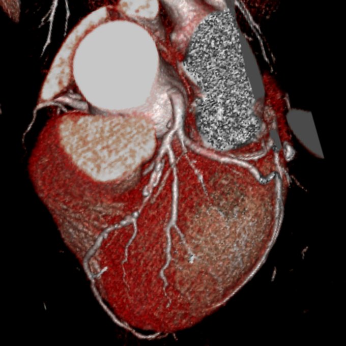 Фото сосудов сердца. Мультиспиральная кт сердца и коронарных артерий. Кт сердца и коронарных сосудов с контрастированием. Мультиспиральная кт коронарных сосудов. Мультиспиральная кт сердца сосудов сердца.