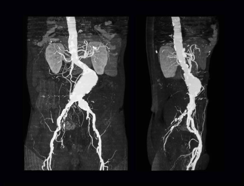 Аневризма брюшной аорты фото