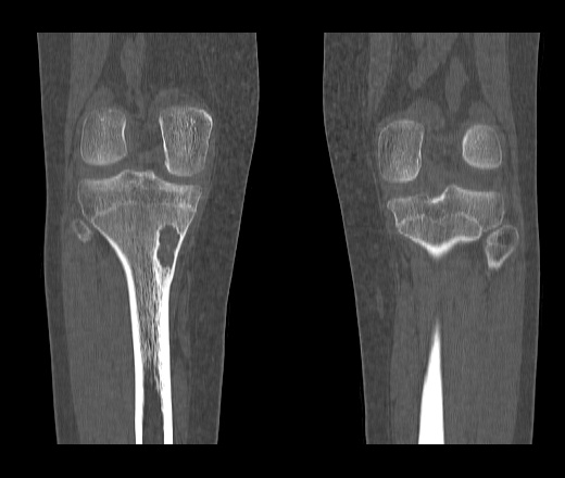 Сделать кт коленного. Неоссифицирующая фиброма большеберцовой кости кт. Неоссифицирующая фиброма бедренной кости кт. Фиброма бедренной кости кт. Киста большеберцовой кости кт.
